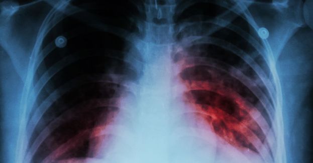 tuberculosis-outbreak-health-emergency-declared-in-california-are-you-at-risk