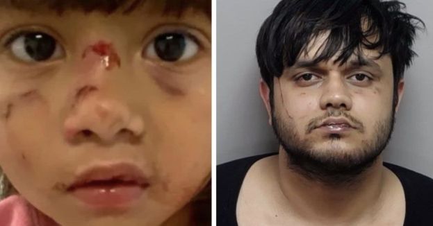 This Is Insane: Toddler Loses Teeth In Alleged Face-Biting Rampage By Illegal Immigrant