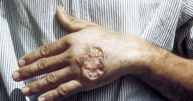 CDC's Alarming Warning: Mysterious Skin-Disfiguring Parasite Spreads In Southern States